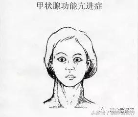 生气上火能得甲亢吗,熬夜易得甲亢