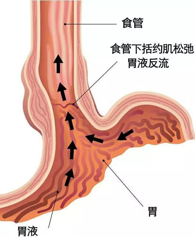 总是烧心胃难受,胸口烧心反酸晚上睡不好
