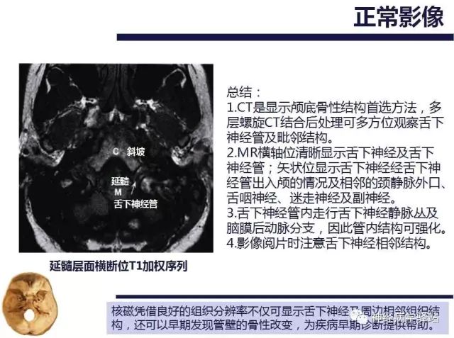 舌下神经和舌咽神经的解剖图,颊神经舌神经解剖图