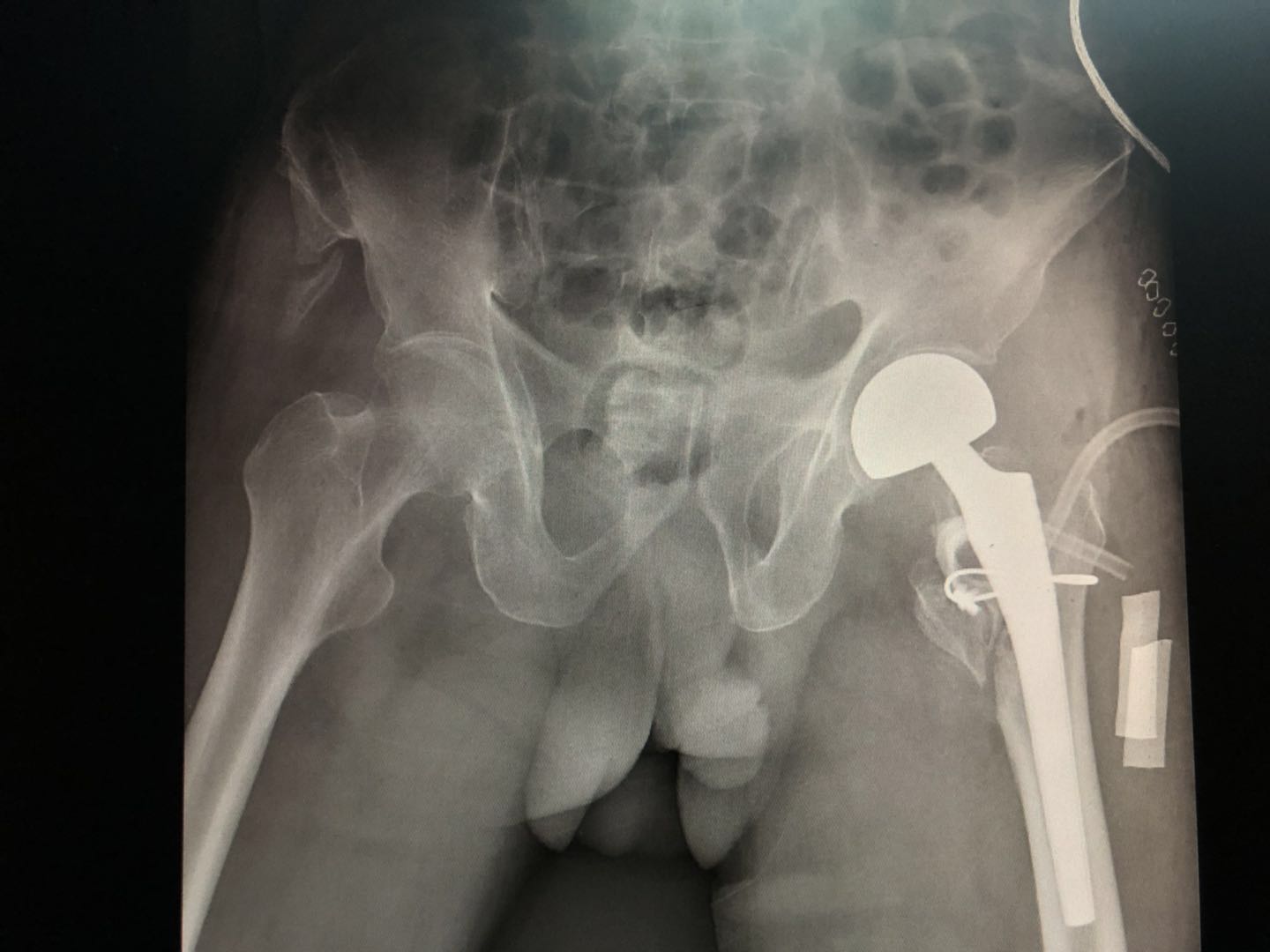 什么病做手术存活下来的几率低,什么病需要过一段时间才做手术