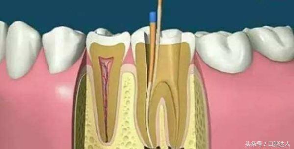 根管治疗后戴牙冠有什么不适感,根管治疗后戴牙冠有什么感觉吗