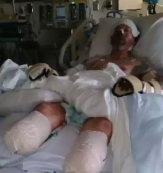 又一例！他严重感染四肢被截，竟只因被狗狗舔了一下……