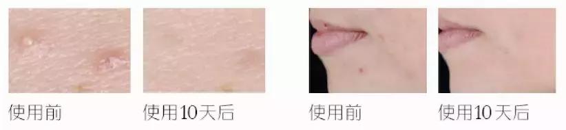 战痘技巧｜林允儿和小甜甜的痘痘可不是一回事