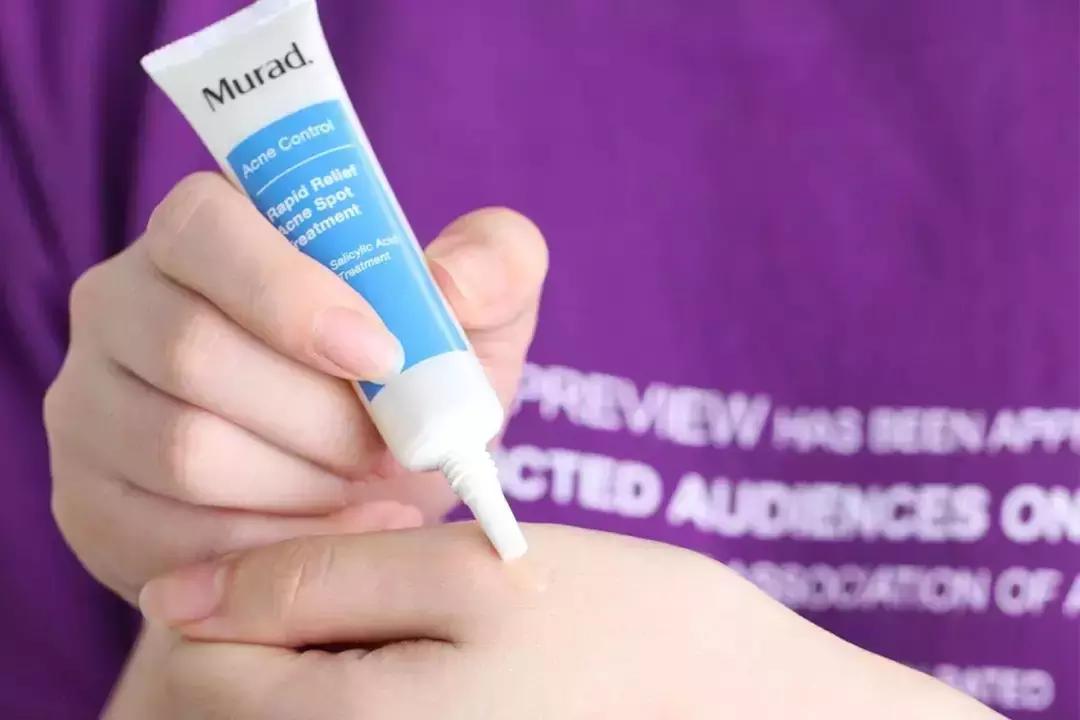 战痘的四个小方法,战痘女孩的秘笈