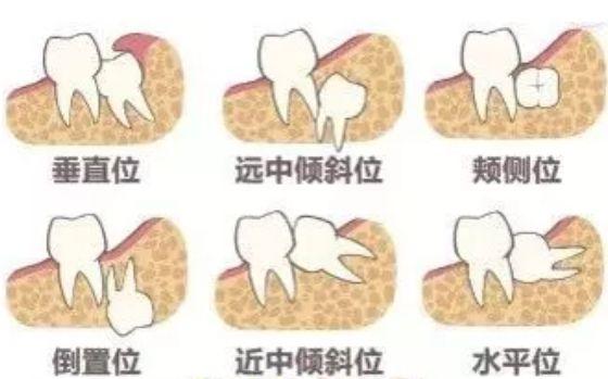 别把牙疼不当回事！海宁7个月孕妇因此痛失宝宝