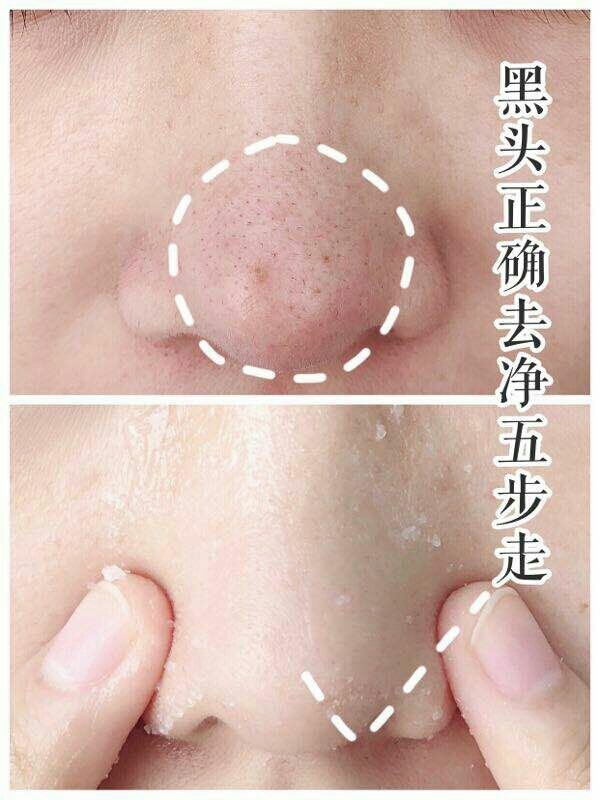 小孩黑头怎么去除最有效的方法,脸上黑头粉刺毛孔粗大怎么去除