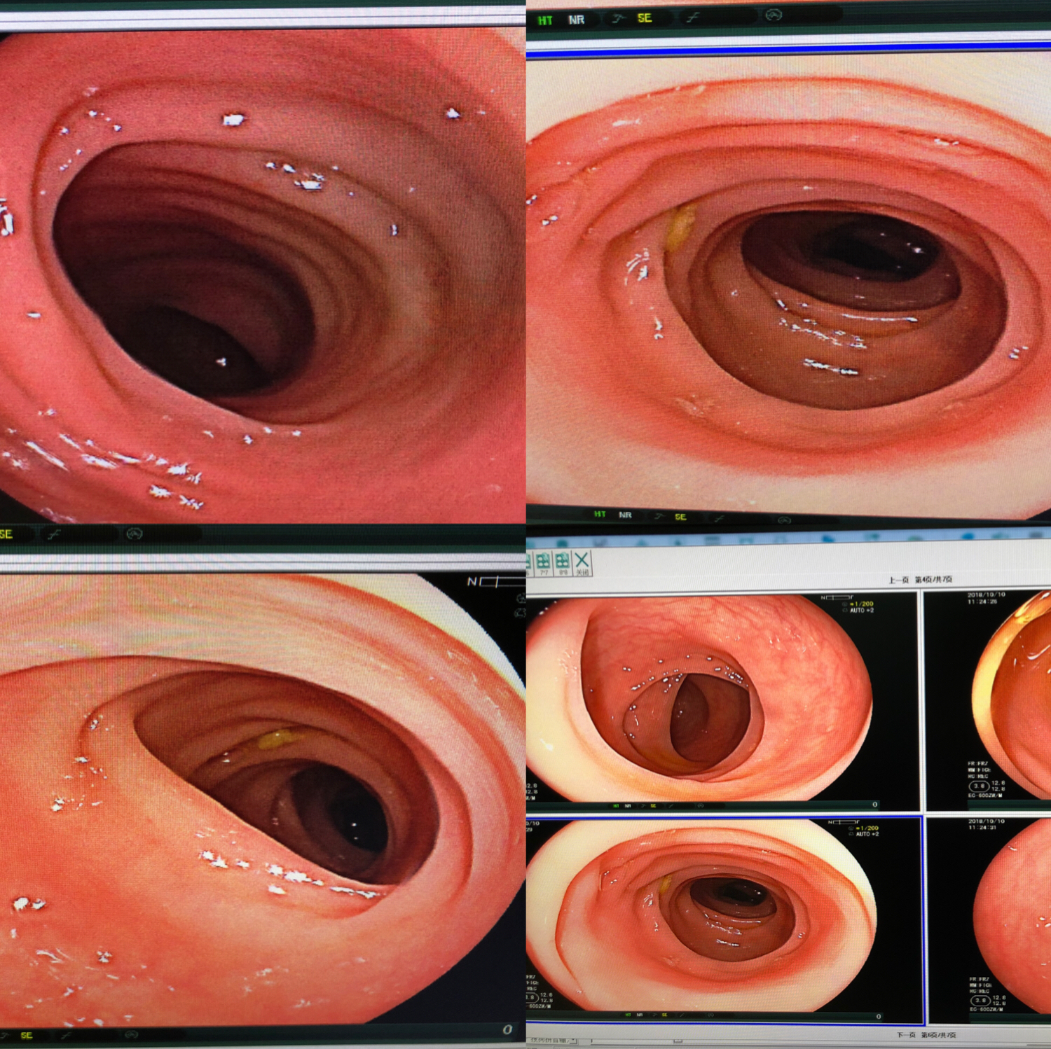 做肠镜前饮食有什么注意,在做肠镜之前饮食方面应注意什么