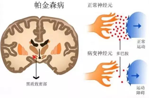 「专家讲健康」康复中心戚成奎主任：手会抖是怎么一回事？