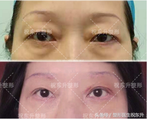 做眼袋提眉手术能变得年轻吗,哪种人不适合做提眉去眼袋