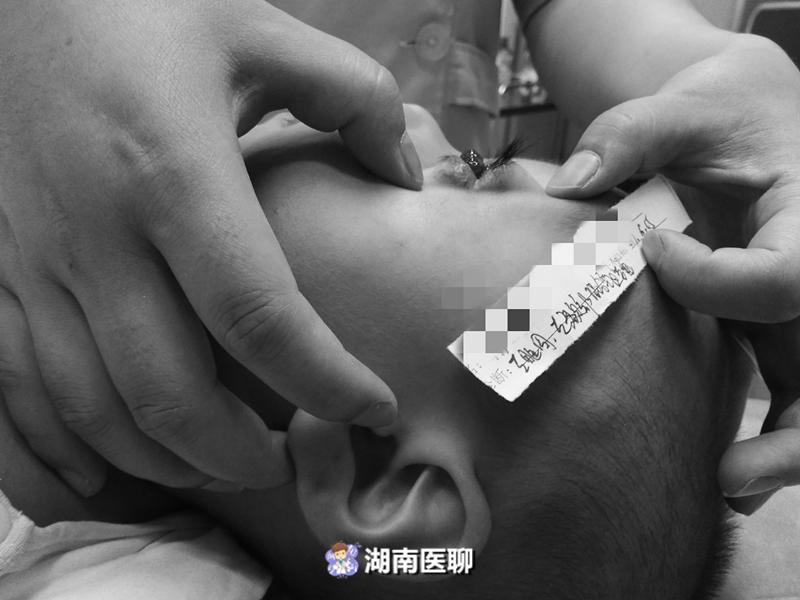 新生儿脸上有褐色胎记可以去掉吗,新生儿脸上红色的胎记能处理吗