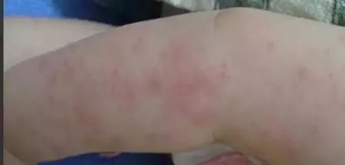 秋季宝宝身上长痒疙瘩,秋季孩子身上痒是什么原因