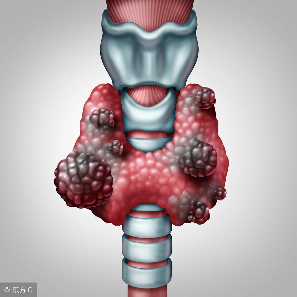 癌症患者失声,突然失声警惕癌症