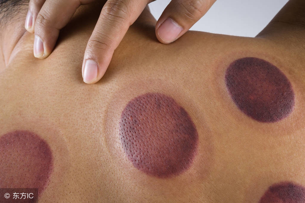 拔罐时出现罐印红是怎么回事,拔罐后的罐印对照表