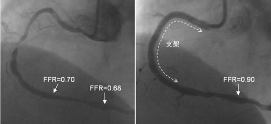 心脏血管狭窄95%必须下支架吗,心脏血管狭窄80%一定要下支架吗