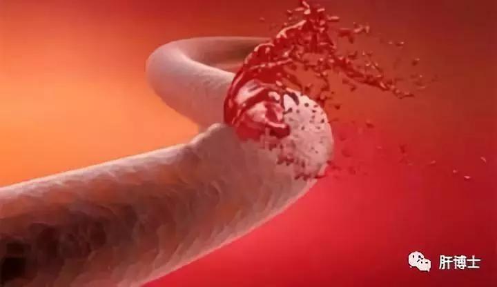 肝硬化引起食管静脉曲张轻度,肝硬化食道静脉曲张的治疗方案