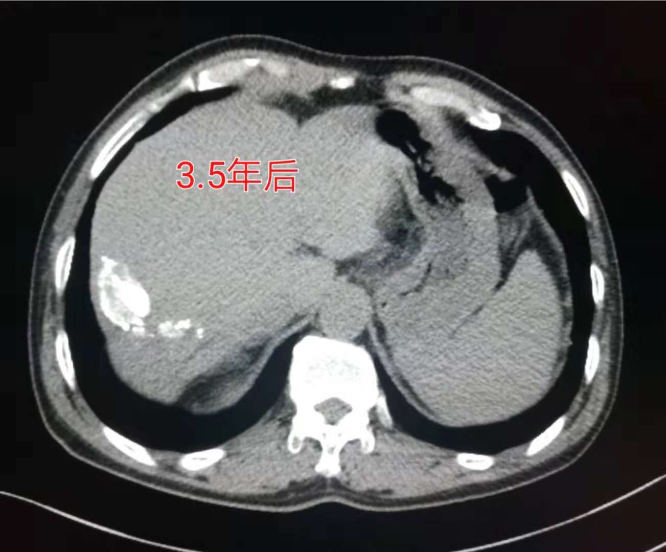 13岁女孩咳嗽半个月确定肺癌,咳嗽一个多月肺癌还有救吗