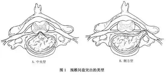 颈椎间盘突出微创手术,什么原因引起颈椎间盘突出