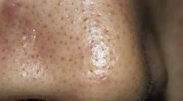 黑头一抹净针对黑头立竿见影,黑头怎么去除立竿见影