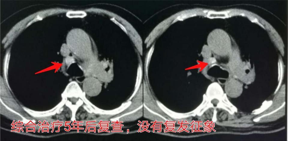 癌症晚期带病长期生存,癌症患者的生存记录