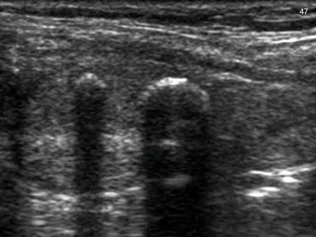 甲状腺彩超报告有钙化怎么办?!