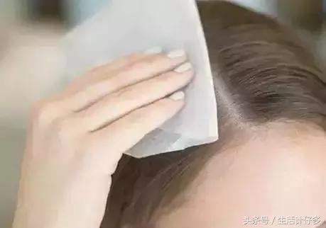 为什么全家人都有头皮屑,18岁女孩头皮屑多为什么