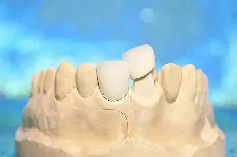 烤瓷牙与全瓷牙价格相差多少,烤瓷牙和全瓷牙价格差多少钱