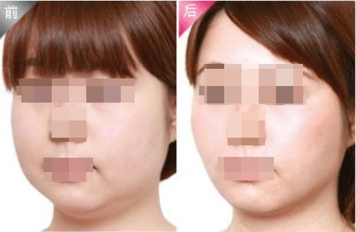 激光溶脂瘦脸要做几次效果最好,激光溶脂瘦脸多久见效