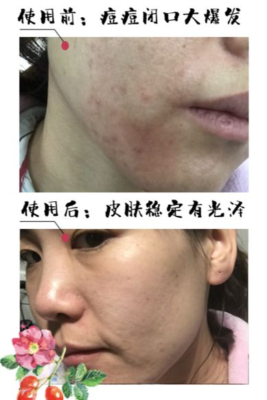 有了全世界3秒卖一瓶的“液体黄金“，干燥、长痘就与你无缘了！