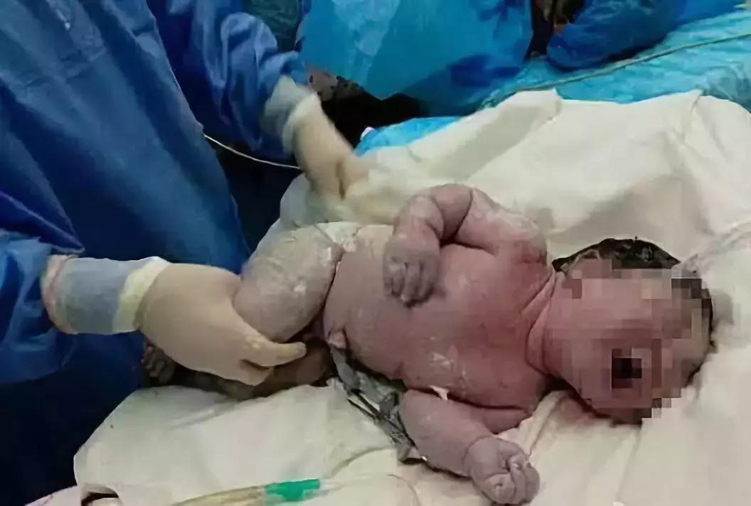 生孩子顺产的好还是剖腹产的好,生孩子顺产的好还是剖宫产的好