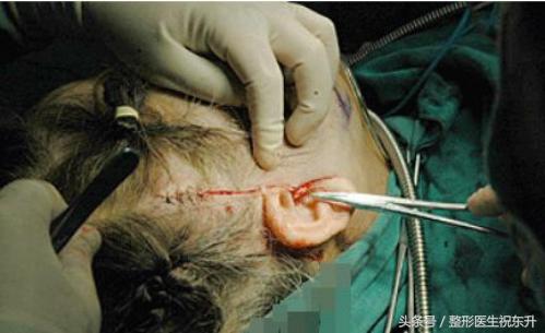 45岁做拉皮手术,44岁女人拉皮手术48天