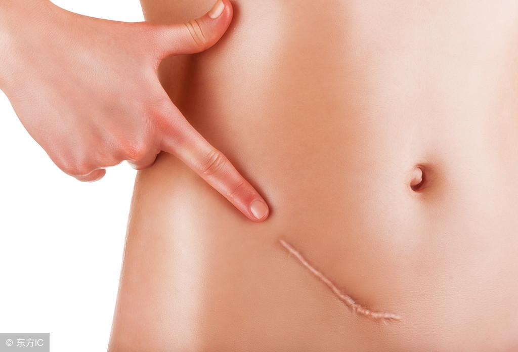 宫颈糜烂的出现到底是清洁不到位还是另有原因呢