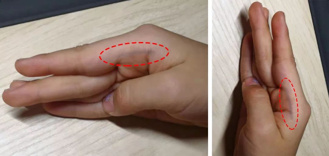 孩子手起水泡脱皮痒怎么办,孩子手脱皮且有臭味怎么回事