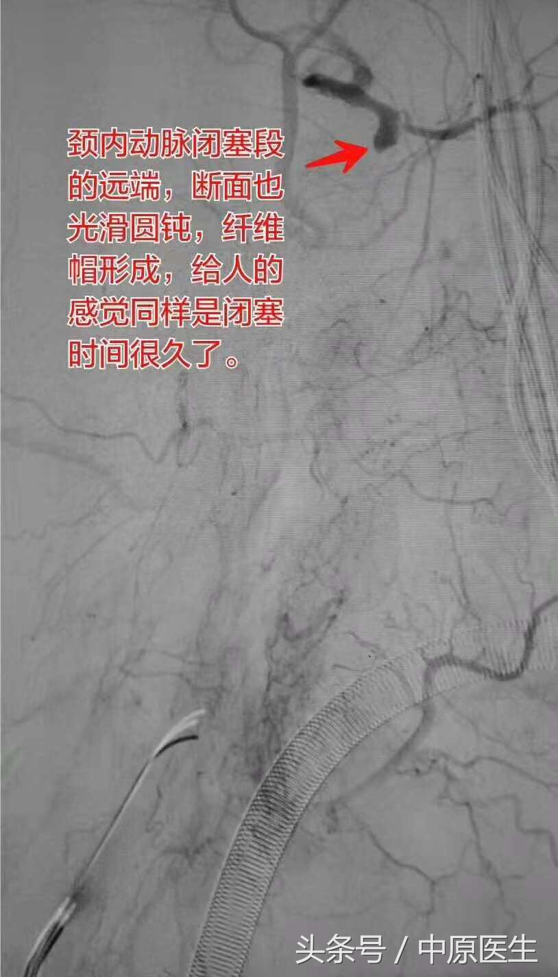 53岁男子脑梗急救室抢救真实纪实,脑动脉闭塞介入治疗视频