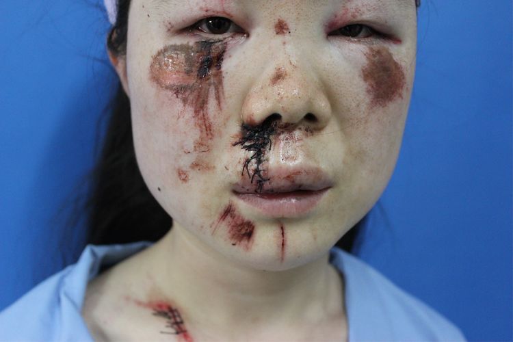 面部外伤后初期疤痕凸起怎么修复,面部外伤凹陷疤痕怎么去除