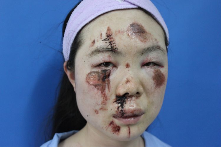 面部外伤后初期疤痕凸起怎么修复,面部外伤凹陷疤痕怎么去除