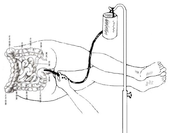 中医肛肠教学,中药灌肠技术有哪几种