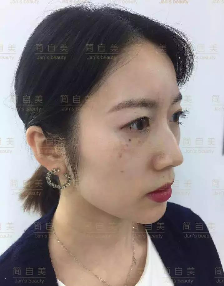 祛斑变美的过程,简美人祛斑祛黄褐斑