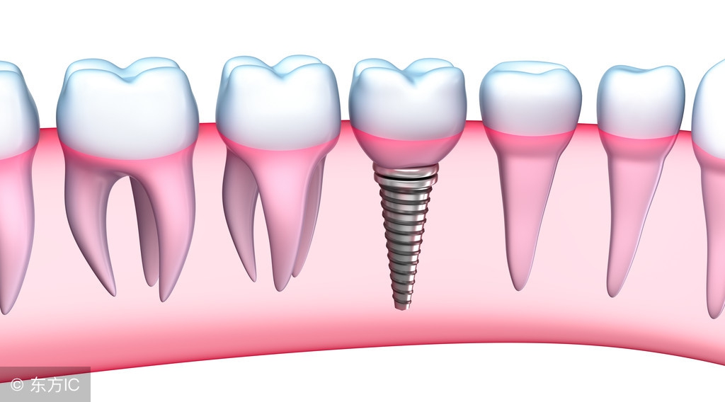 人类第三颗牙齿,为什么种植牙是人类的第三副牙齿