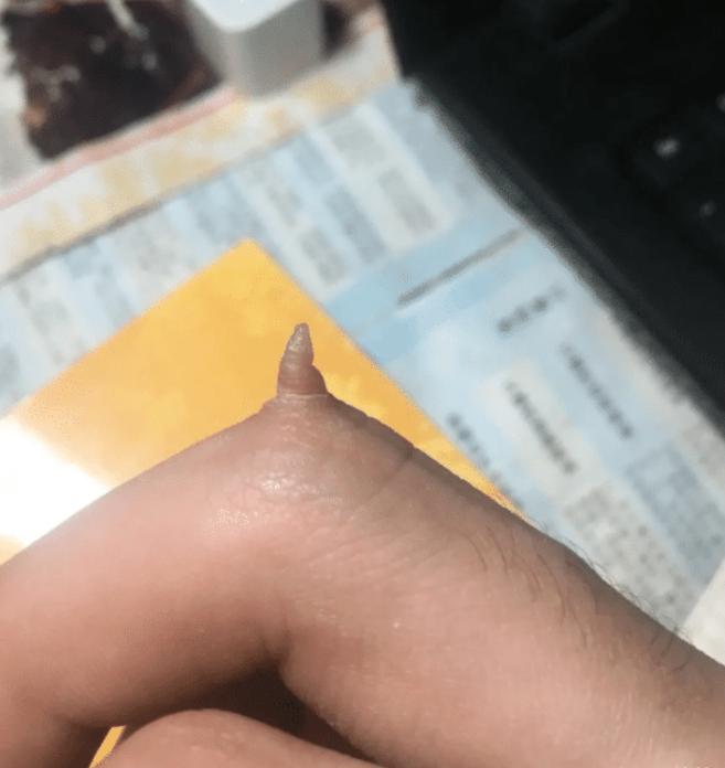 中指长了一个肉球,中指肉掉了一块还能长出来吗
