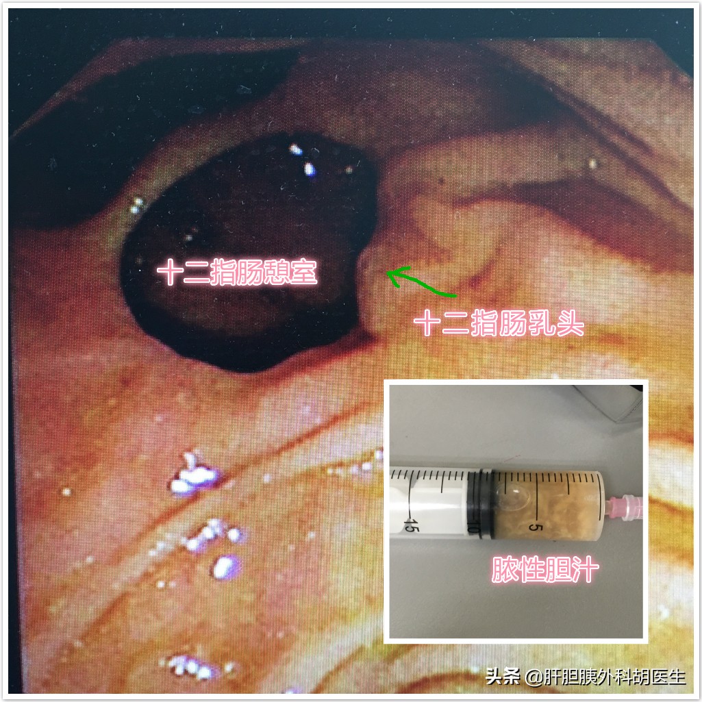 急性胆管炎应该怎么诊治,急性梗阻性化脓性胆管炎