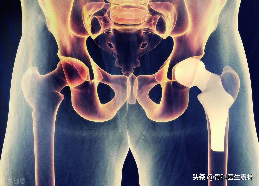 髋关节滑膜炎的症状及治疗方法,髋关节滑膜炎怎么造成的