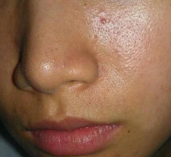 脸上毛孔粗大可以用什么护肤品,毛孔粗大的五个纯天然护理偏方