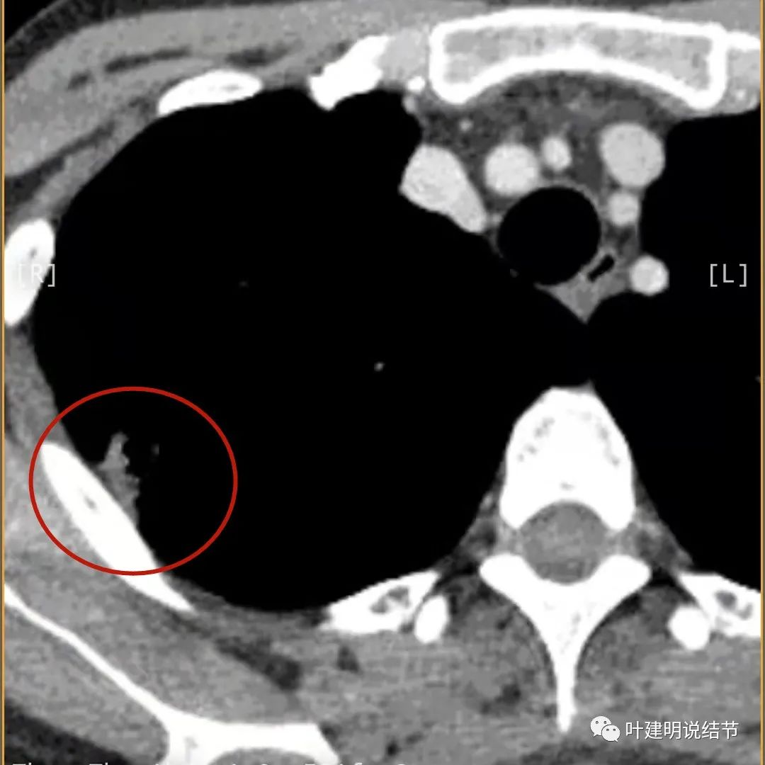 临床诊断孤立性肺结节,空洞型结节一般是什么性质