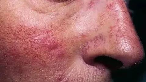 脸发红发烫小妙招有效改善红脸蛋,在暖气屋里脸发红发烫是怎么回事