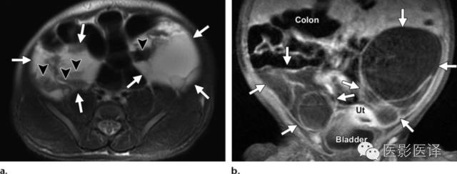 胎儿卵巢囊肿5.6厘米会消失吗,卵巢巨大囊肿与妊娠鉴别