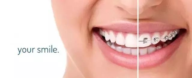 新款牙齿矫正价格,牙齿矫正性价比高品牌