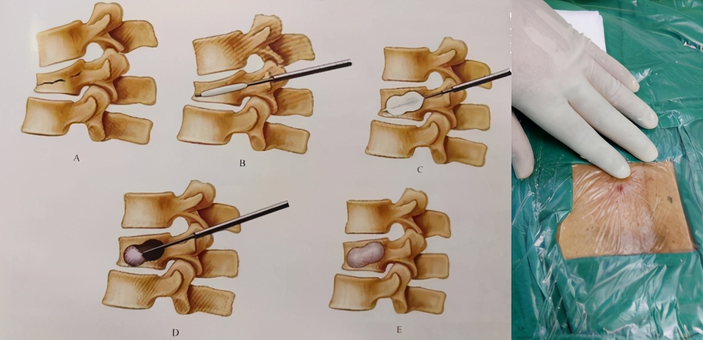 腰椎骨折能保守就不要做手术?身体不好的老年人怎么办?
