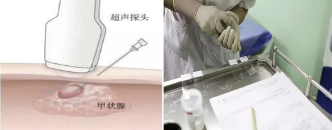 甲状腺结节频发，该拿它怎么办才好？