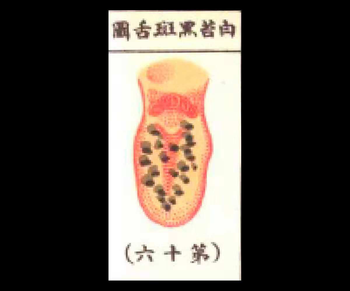 白苔裂纹舌有齿痕是什么原因,舌头白苔厚舌根有红点是什么原因