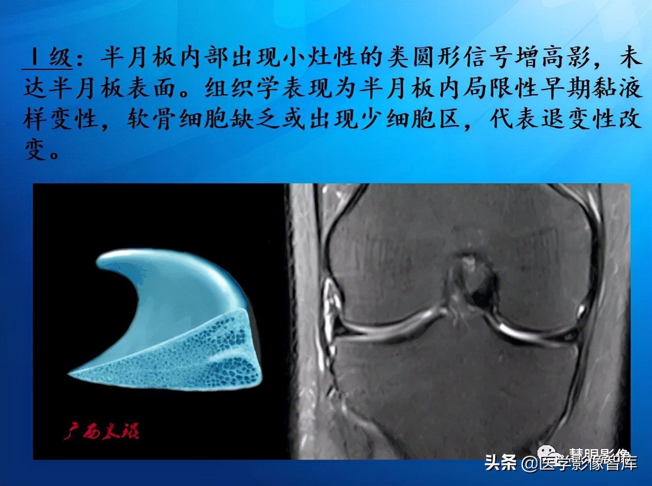 膝关节半月板损伤的解剖结构图,半月板mri解剖图解